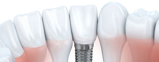 Dental Implants, Langley Dentist