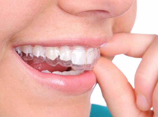 Invisalign Clear Braces, Langley Dentist