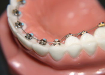 Braces & Invisalign, Langley Dentist