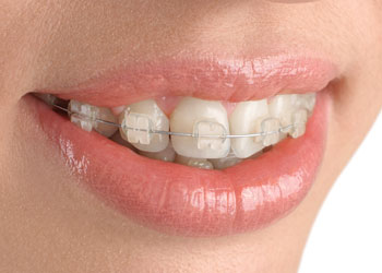 Translucent Cosmetic Braces, Langley Dentist